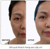 Chương trình ưu đãi đặc biệt dành cho khách hàng làm đẹp bằng phương pháp cấy chỉ tại Khoa Y học cổ truyền
